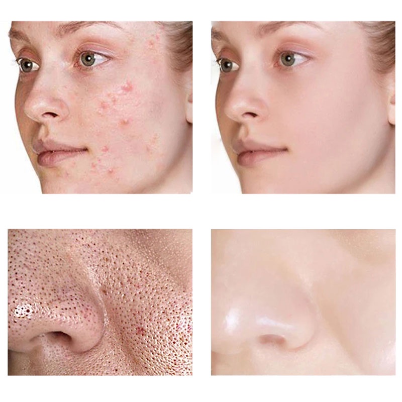 Salicylic Acid Pores Refining Cream Shrink Pore Improve Acnes