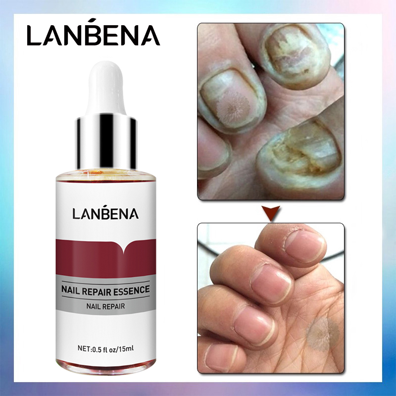 LANBENA Nail Repair Essence Serum Fungal Nail Treatment Remove ...
