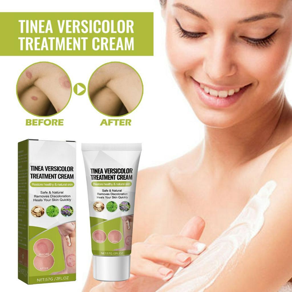 Tinea Versicolor Treatment Antifungal Cream for Tinea Versicolor