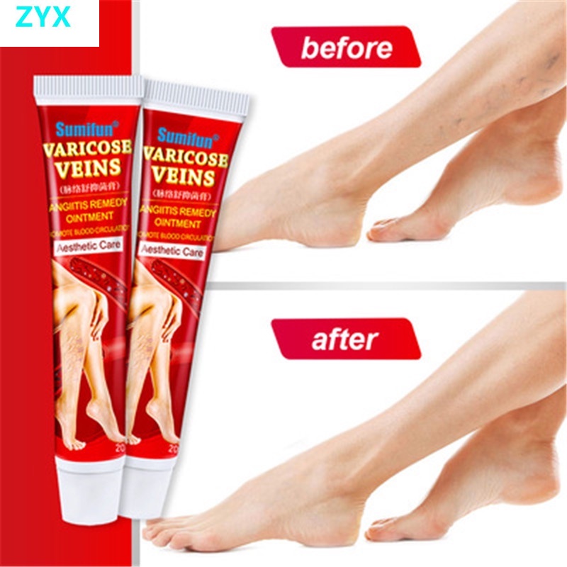 Sumifun 20g New Varicose Vein Treatment Cream Vasculitis Phlebitis