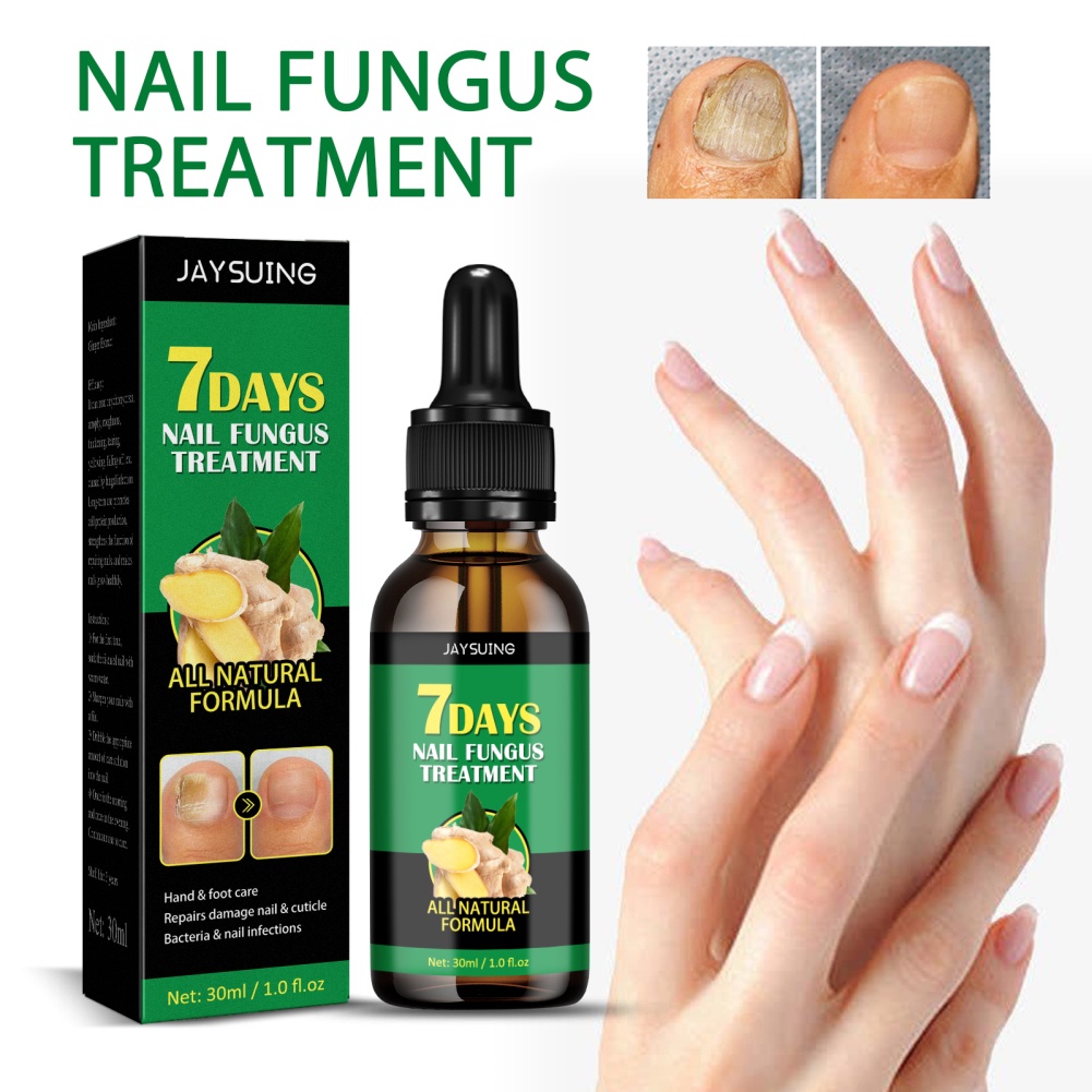 Jaysuing Ginger Nail Care 7 Days Fungal Treatment Feet Care Essence ...