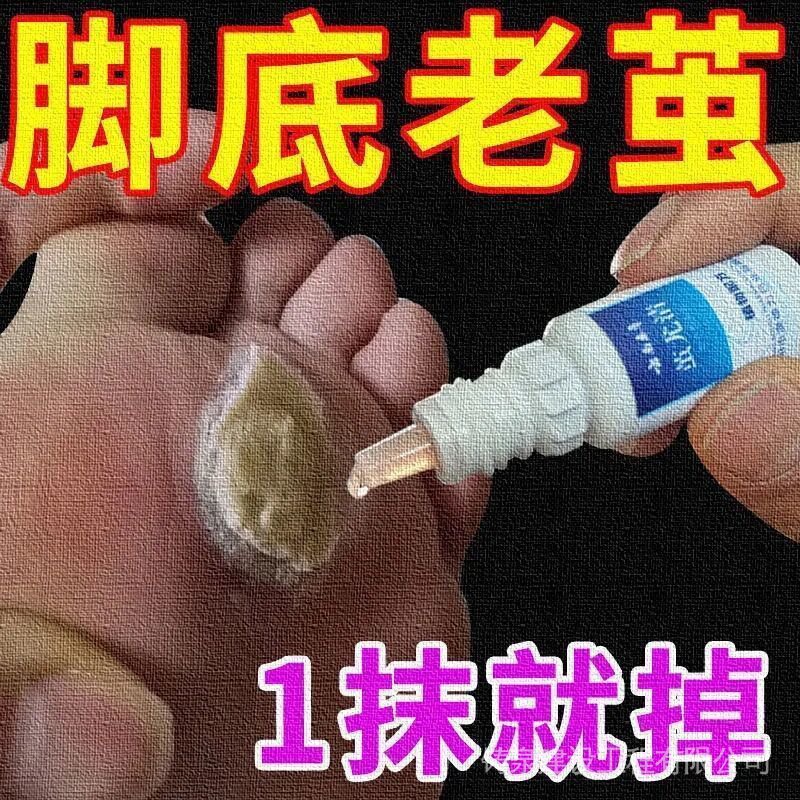 remove-foot-dead-skin-calluses-soles-on-hands-hard-cocoon-softener-toes