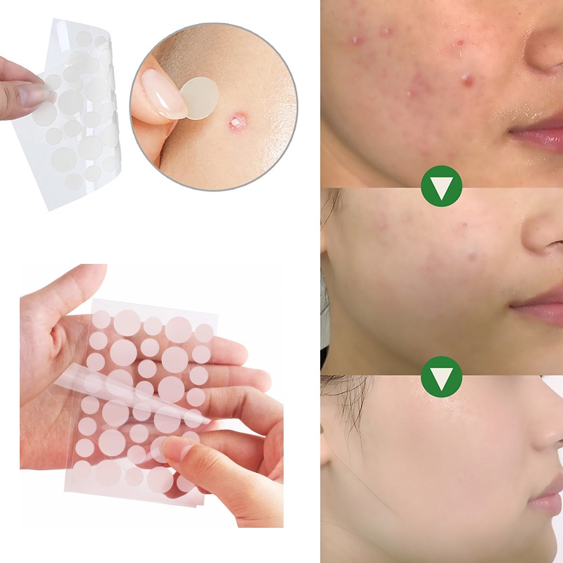 hysent 36 stickers (one piece) acne stickers facial invisible stickers ...