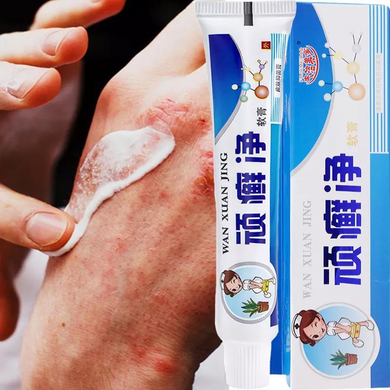 25g Psoriasis Cream Ointment Treatment Dermatitis Eczema Scaly Plaques Psoriasis Tinea Pedis
