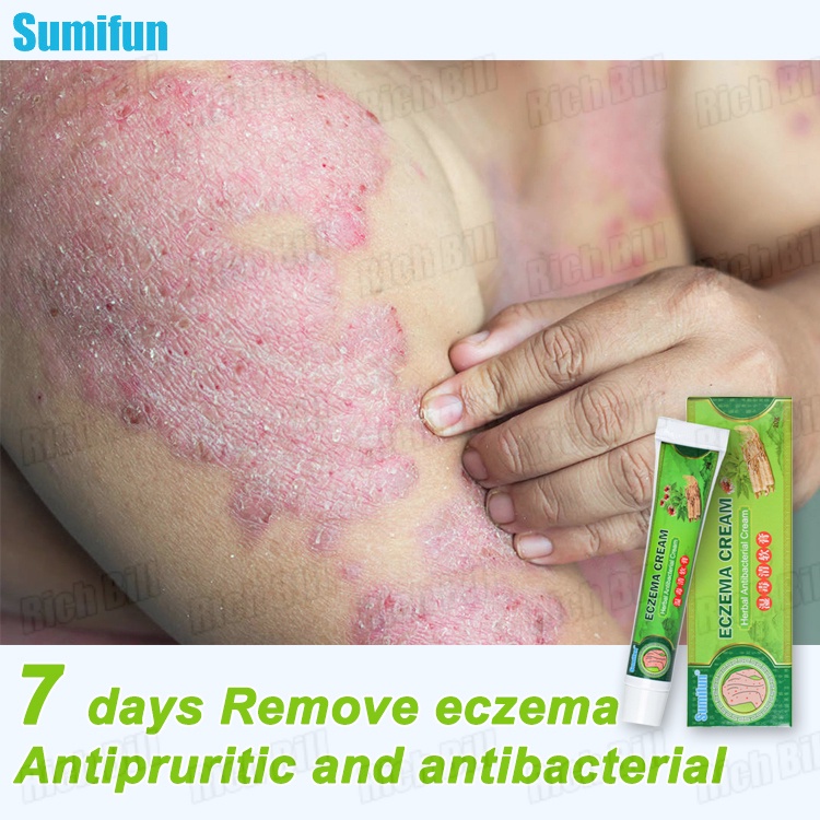 dermovate ointment 【Sumifun】 Eczema Cream Psoriasis Cream Eczema Ointment Ringworm and Fungal Oi