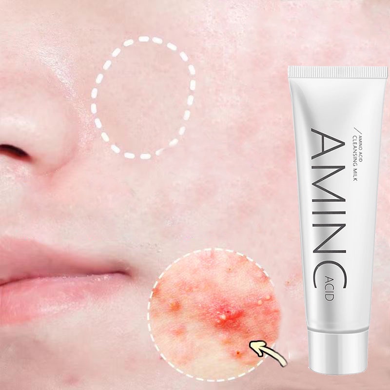 Buy 2 take 1 Acne cream skin care products pimple marks removerponds