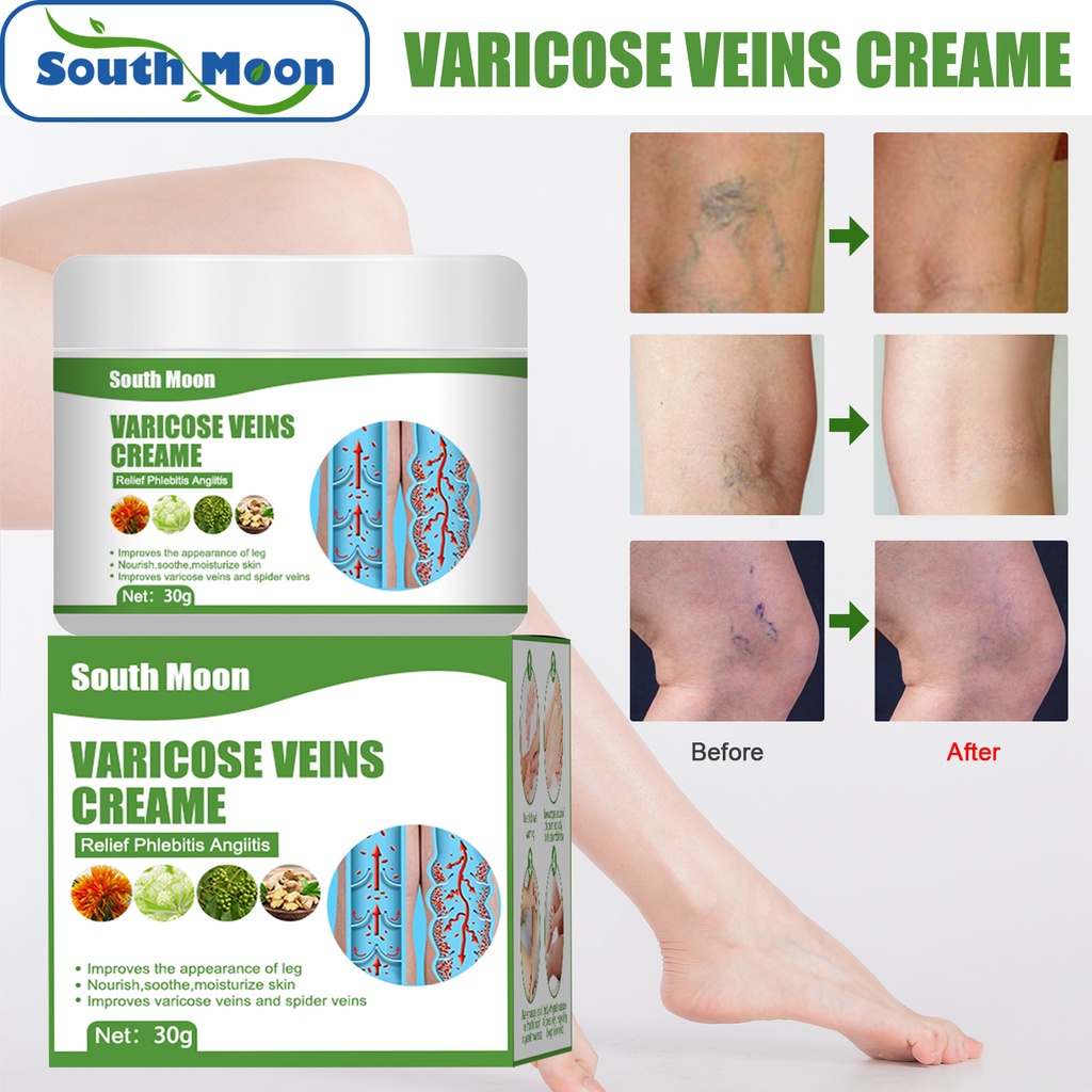 south moon Varicose Vein Spider Varicose Vein Remover Cream Pain Relief