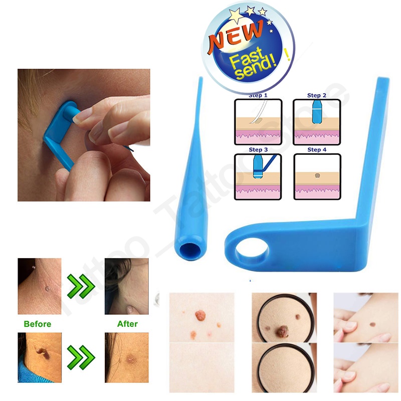 Medical Skin Tag Kill Skin Mole Wart Remover Micro Band Skin Tag Removal Kit With Cleansing