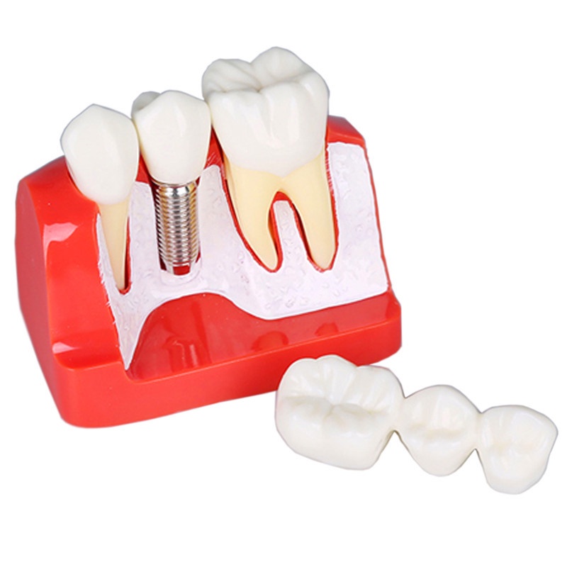 Dental Implant Teeth Model with screw Detachable 4 Times Teeth Model ...