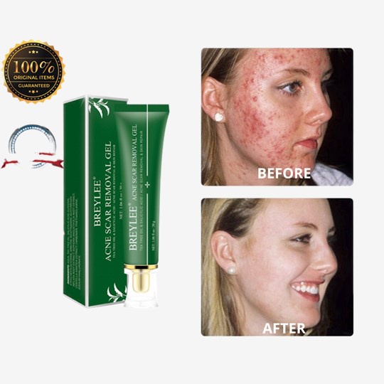 100% Original BREYLEE Acne Treatment Cream Anti Acne Face Gel Pimple