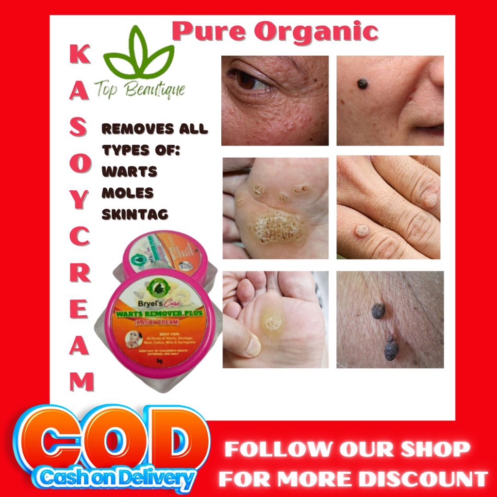TOP BEAUTIQUE Effective Pure Organic Warts Remover Kulugo Milia ...