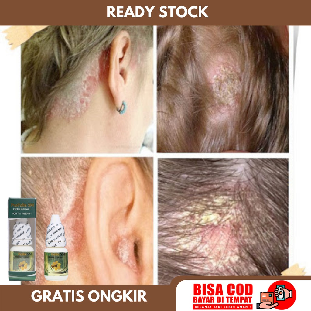 Severe Dandruff Medicine, Scalp Removal, Psoriasis, Scalp Ringworm ...