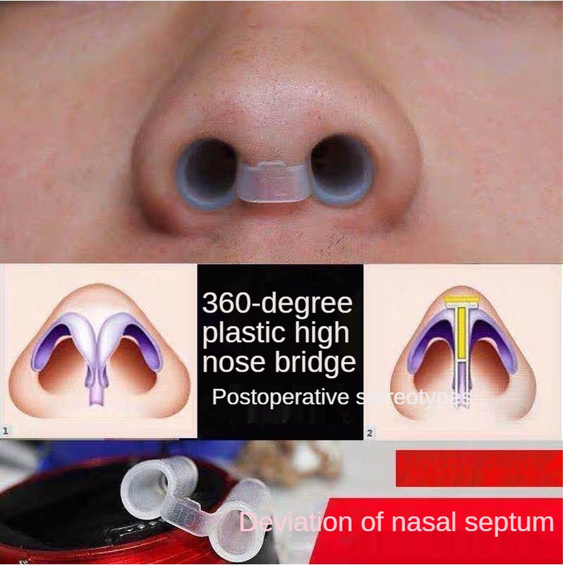 Synthetic rhinoplasty after nasal augmentation Synthetic rhinoplasty ...