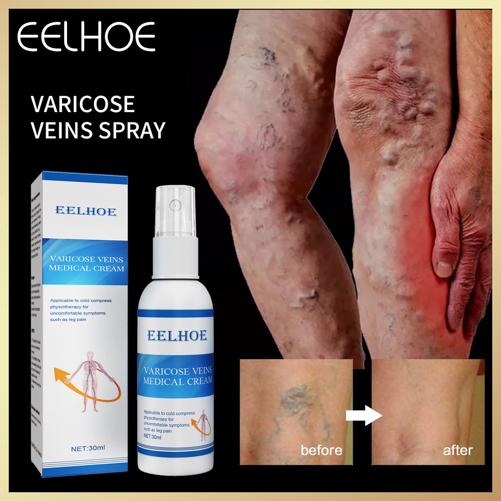 EELHOE Natural Varicose Veins Spray Serum For Legs Care Vasculitis ...