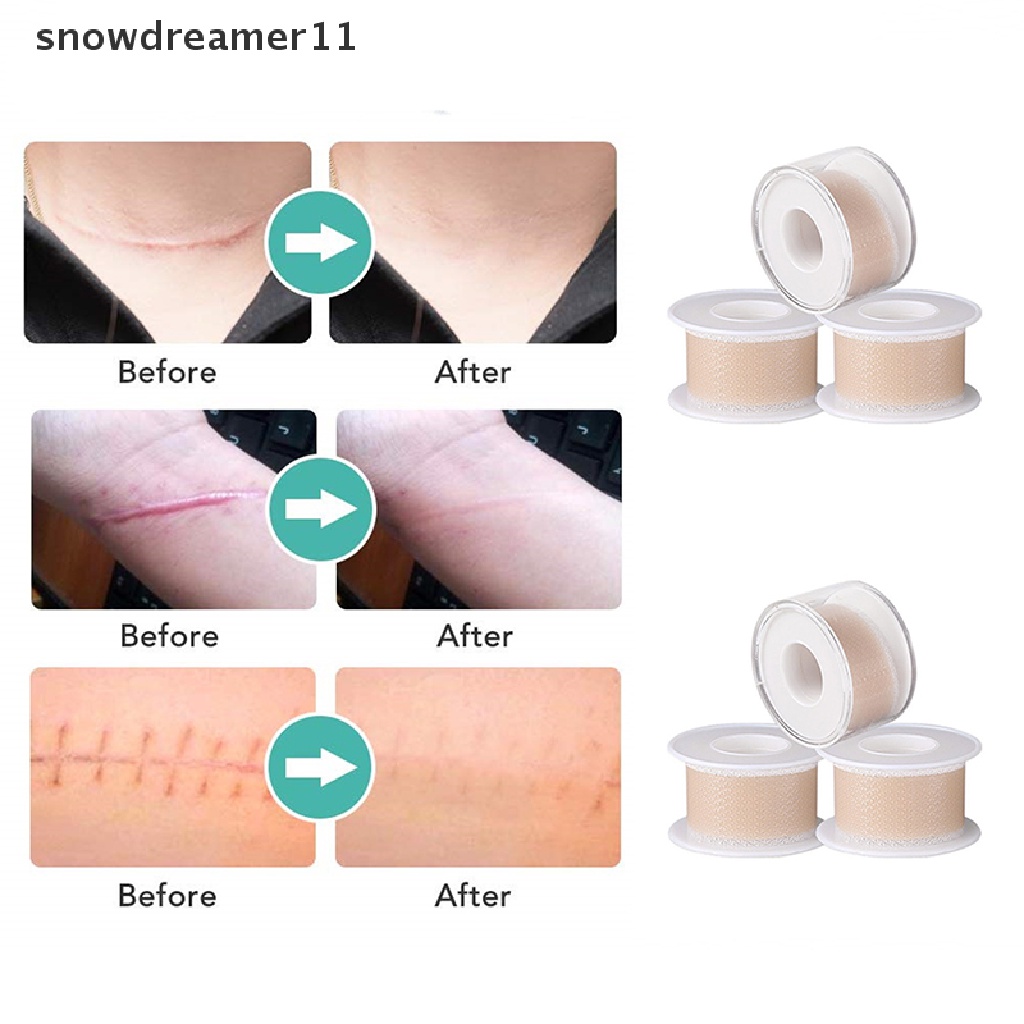 Snph Efficient Surgery SelfAdhesive Silicone Gel Tape Trauma Burn Scar