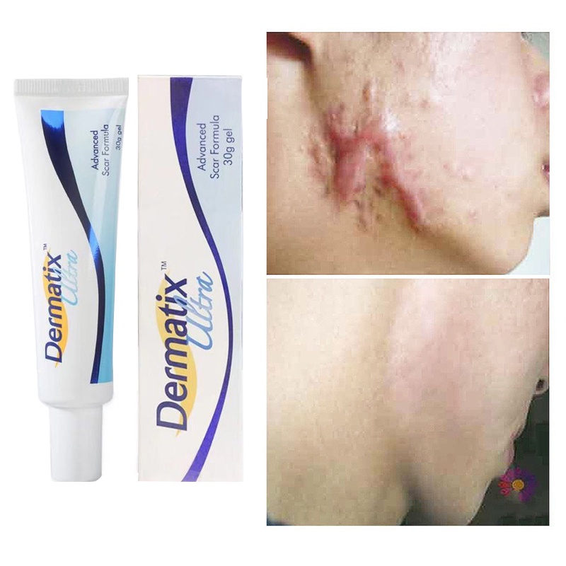 Buy1 Get1 Acne Scar Removal Cream Scar Repair Cream Pigmentation