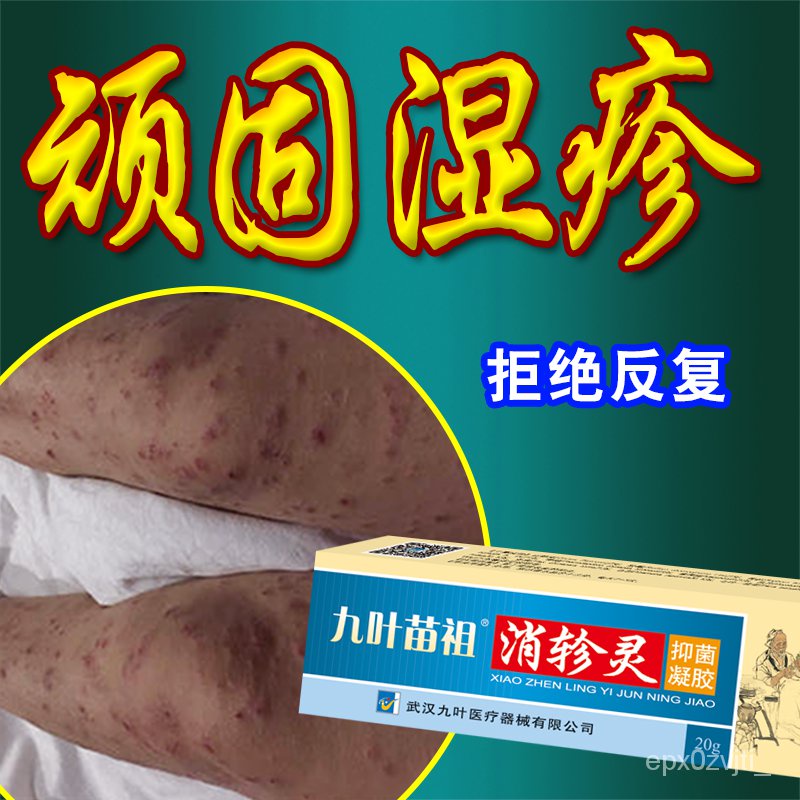 Eczema Ointment Hives, Herpes, Herpes, Herpes, Allergic Dermatitis, Wet