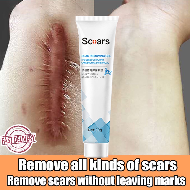 Scar Removal Cream Peklat Remover Acne Treatment Scar remover cream stretch mark Cream Shopee