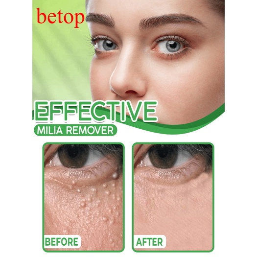 Eye Milia Removal Cream【BEST SELLER】 Shopee Philippines