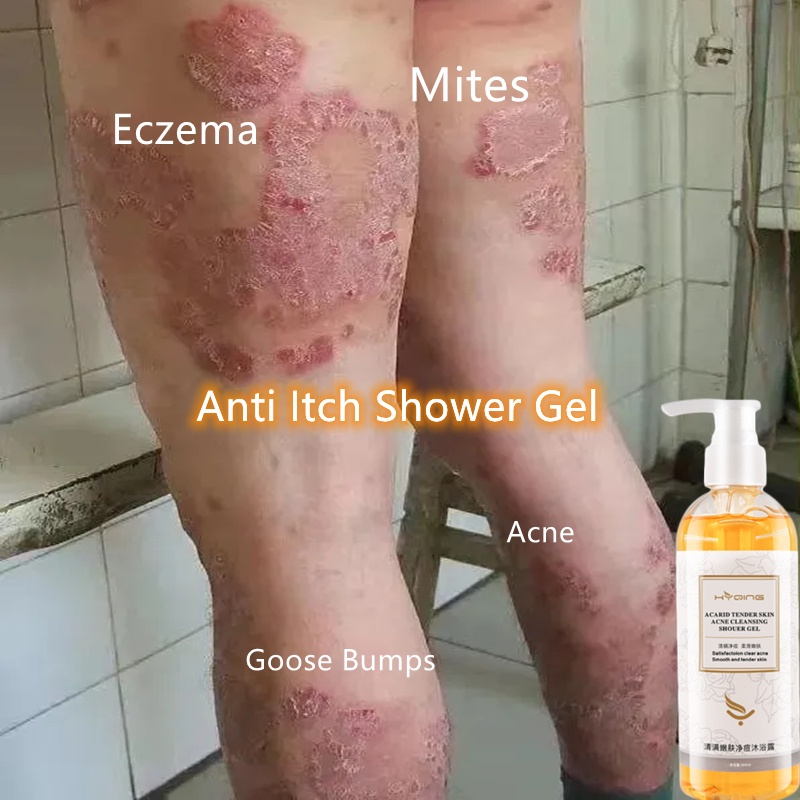 Eczema Shower Gel Anti Itch Acne Mites Psoriasis Antifungal Treatment