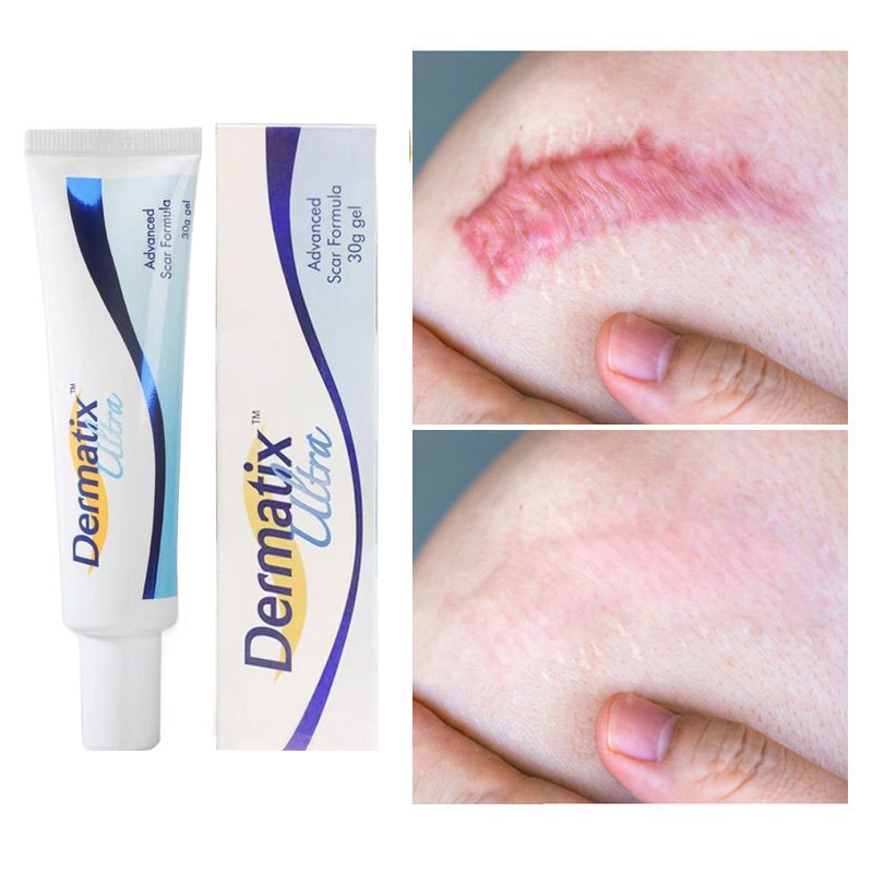 Australia Dermatix Scar Gel Acne Scars Treatment Scar Removal Cream