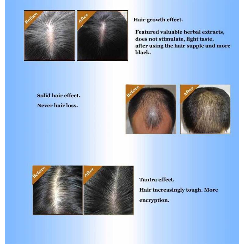 Hair Grower for Men Women Hair Treatment Hair Growth Spray Essence Hair ...