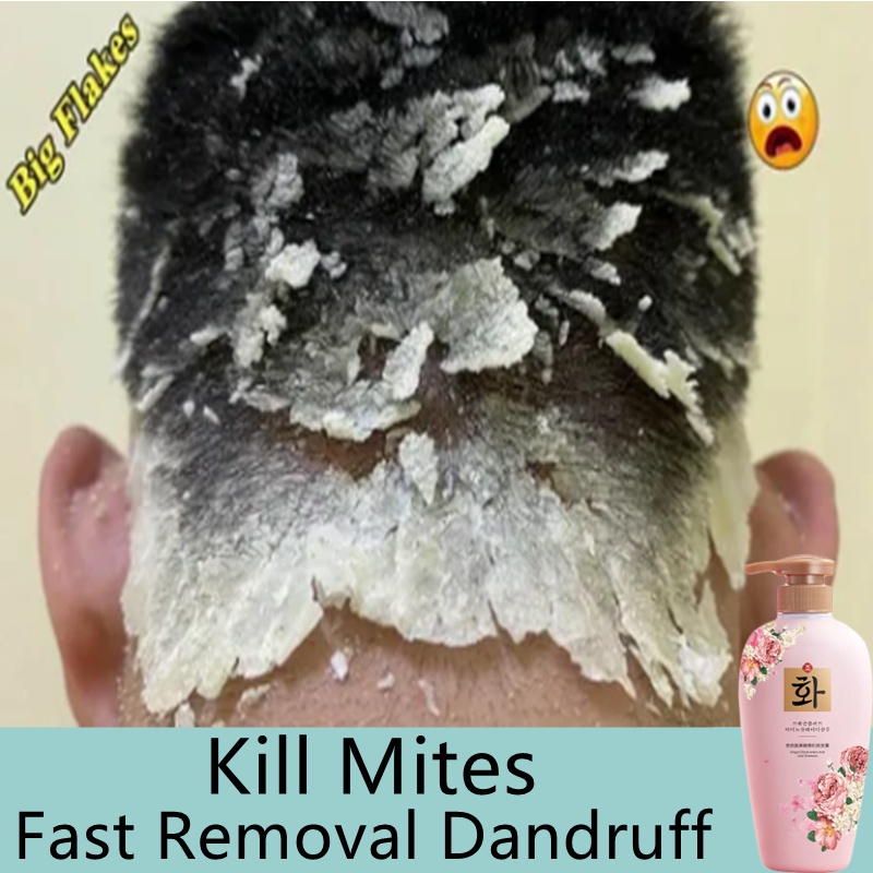 Fast Removal Dandruff Shampoo Kill Mites anti dandruff Anti Itch