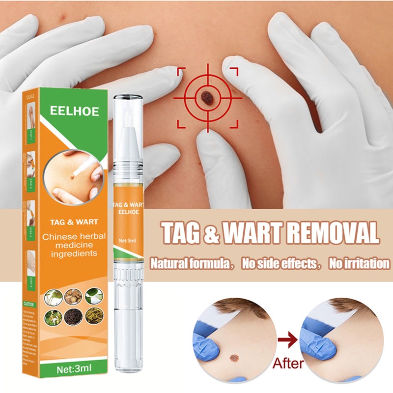 Cod Warts Remover Original Kasoy Oil Warts Remover Warts And Skin Tags Remover Organic Pure