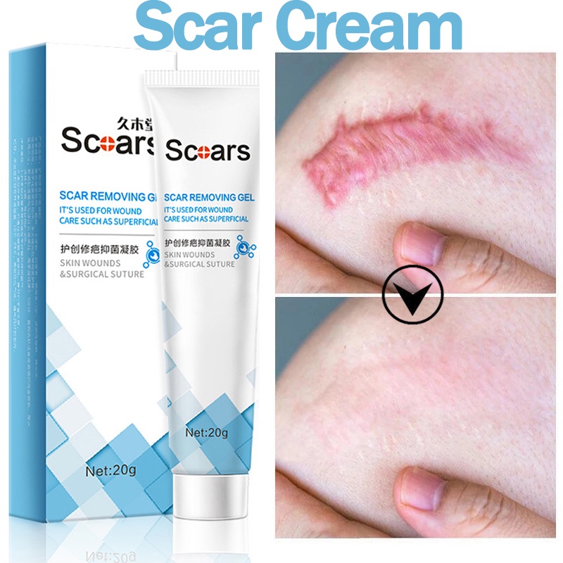 Scar Remover Repair Scar Cream Effective remove Strech Mark Acne ...