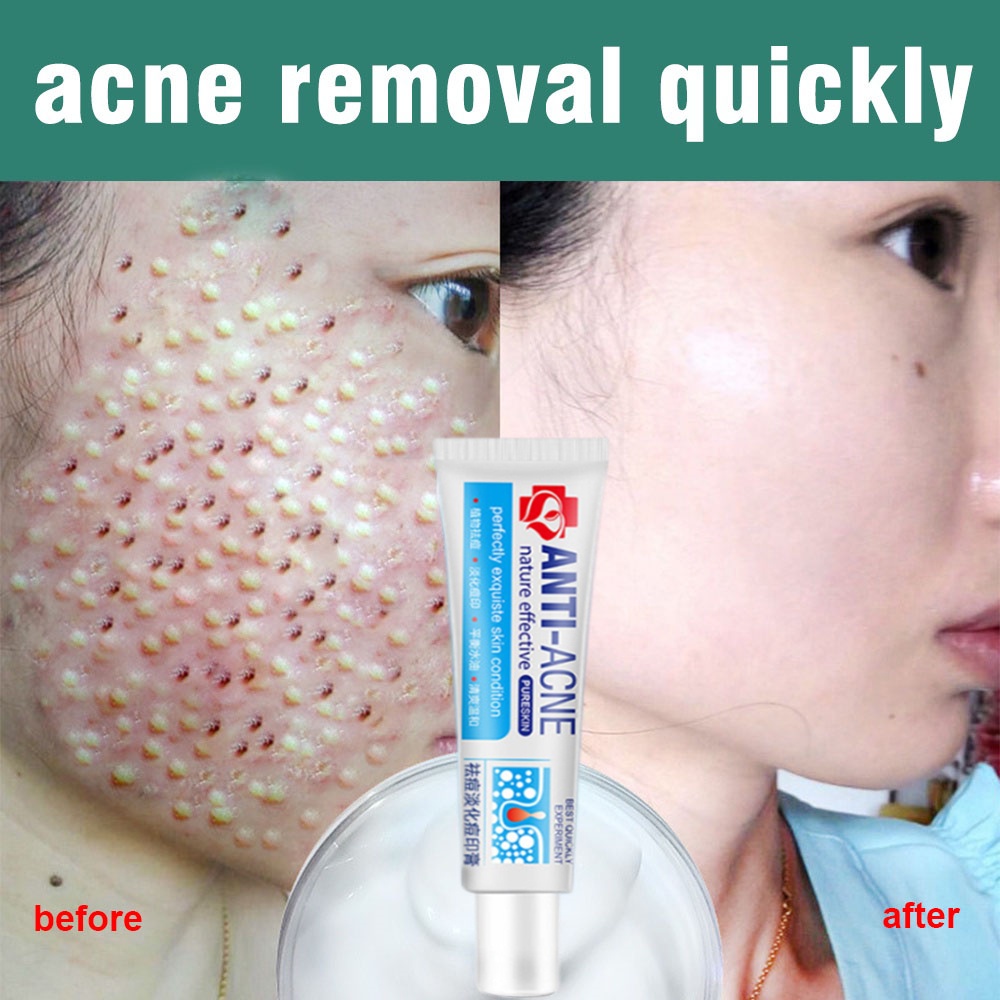 acne pimple cream acne pimple remover pimple marks remover acne scar