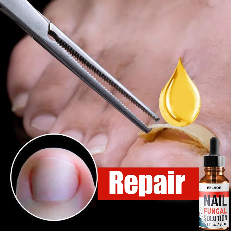 Nail Fungisol Antifungal Nail Fungus Treatment Quickly Bad Nails Fix Bad Nails Inhibit Fungal