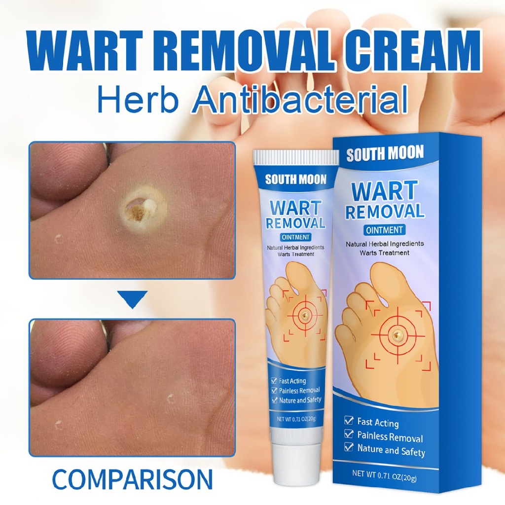 Wart and Mole Remover Cream Natural Extract Corn Plaster Warts Ointment ...