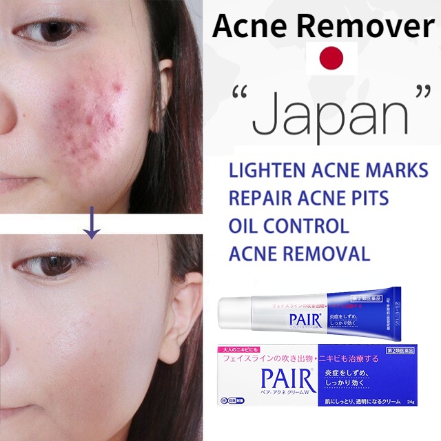 Japan Pair Acne Remover Cream Face Acne Pimple Treatment Skin Repair