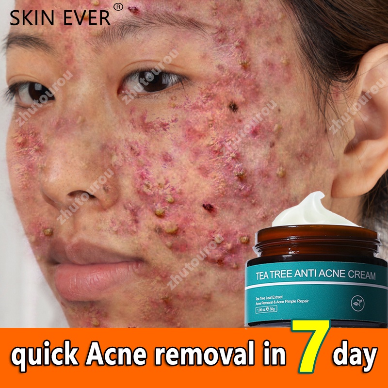 Acne killer SKIN EVER Acne cream tea tree extract, Refreshing and not greasy Acne pimples