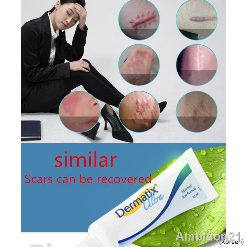 Australia Dermatix Scar Gel Acne Scars Treatment Scar Removal Cream Acne Scar Remover 15g