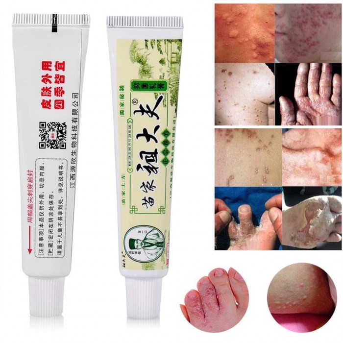 Eczema Ointment For Itching Medicine For Zudaifu Itchy Skin Fungus ...