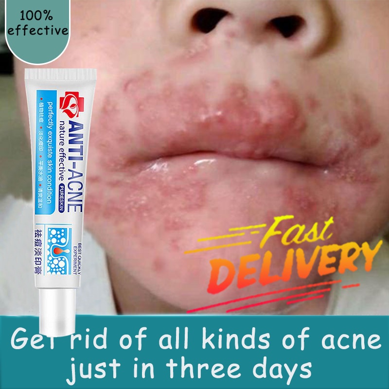 Remove Pimples gel bioderm ointment acne pimples acne marks pimples