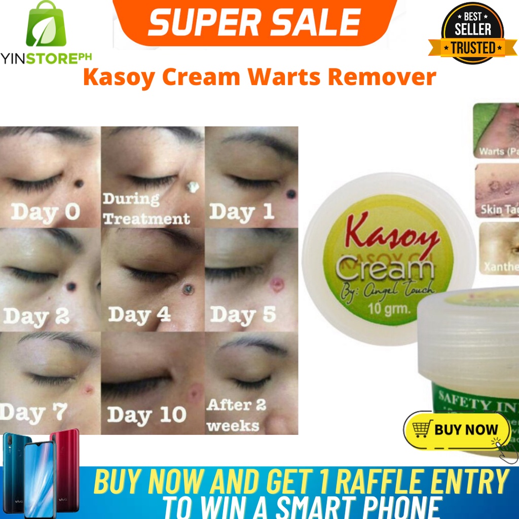 JAK G KASOY CREAM ORIGINAL BEST SELLER- EFFECTIVE WARTS REMOVER 10grams ...