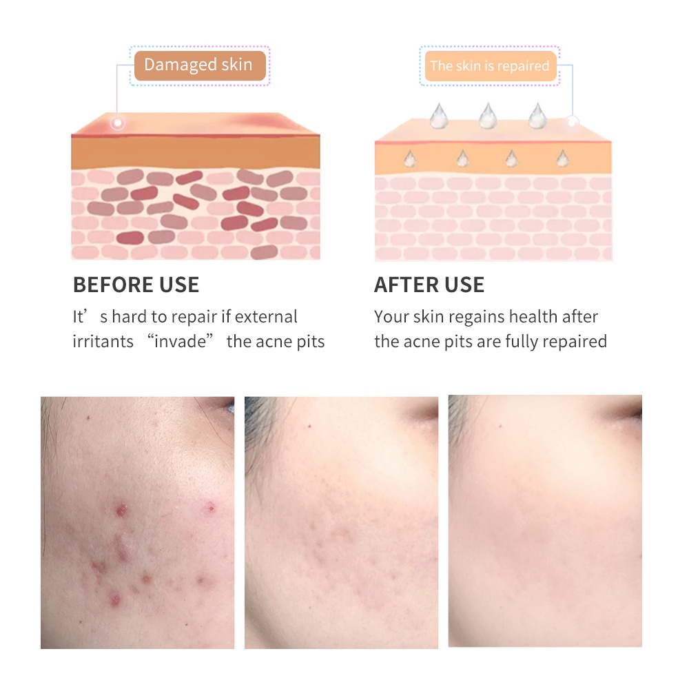 ⋮ BREYLEE Acne Scar Treatment Cream Removal Gel Fade Acne Marks Spots Remove Skin Pigmentation
