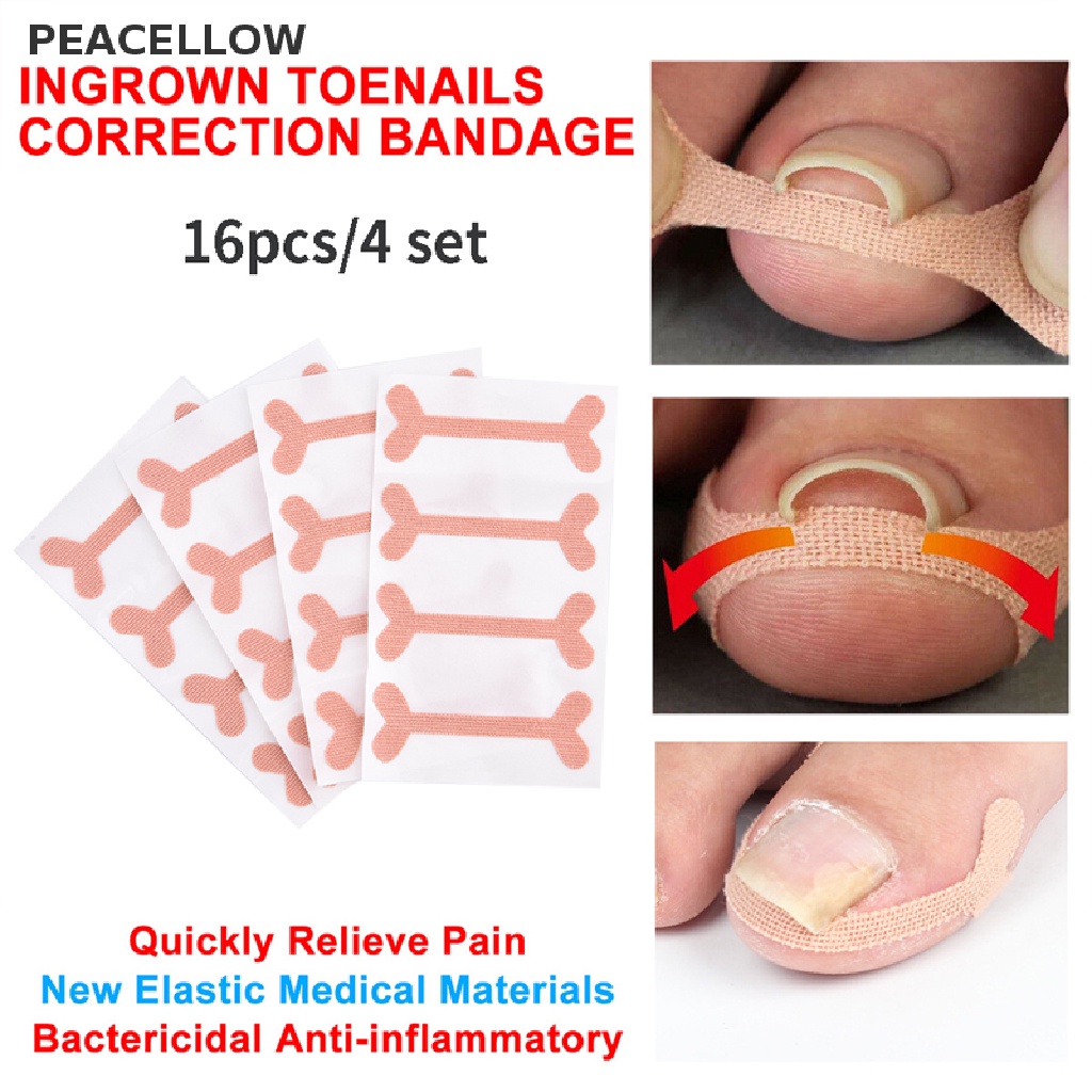 PEACELLOW 16pc Ingrown Toenail Band Aid Relief Pain Paronychia