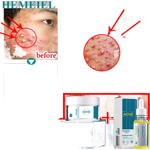 Hemeiel Pimple Marks Removeracne Treatment Setmabisang Gamot Sa Pimples Shopee Philippines 8907