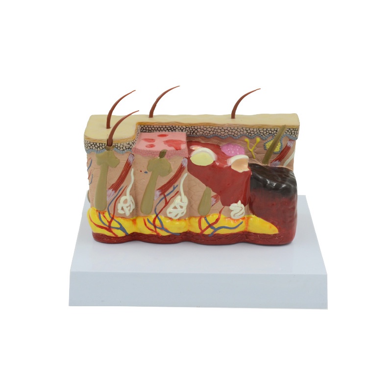 Skin Burn Normal Skin Model Human Body Anatomy Varying Degrees of Skin ...