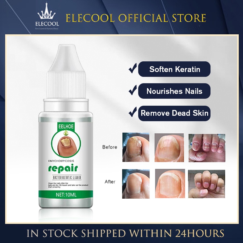 Eelhoe Onychomycosis Repair Liquid Nail Treatment Liquid Thicken Soft