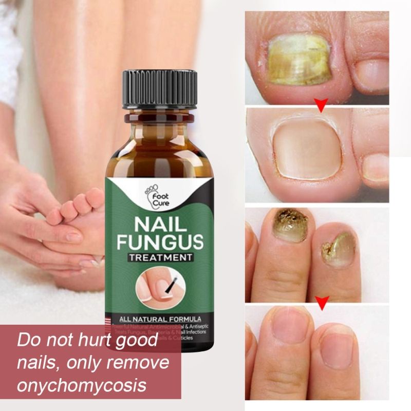 Nail Fungus Treatment, Best Nail Repair, Stop Fungal Growth, Effective ...