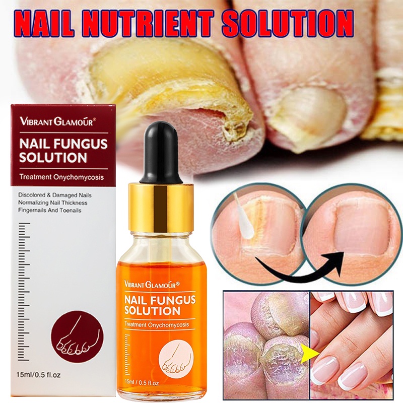 Nail Repair Serum Fungal Nail Treatment Essence Remove Onychomycosis