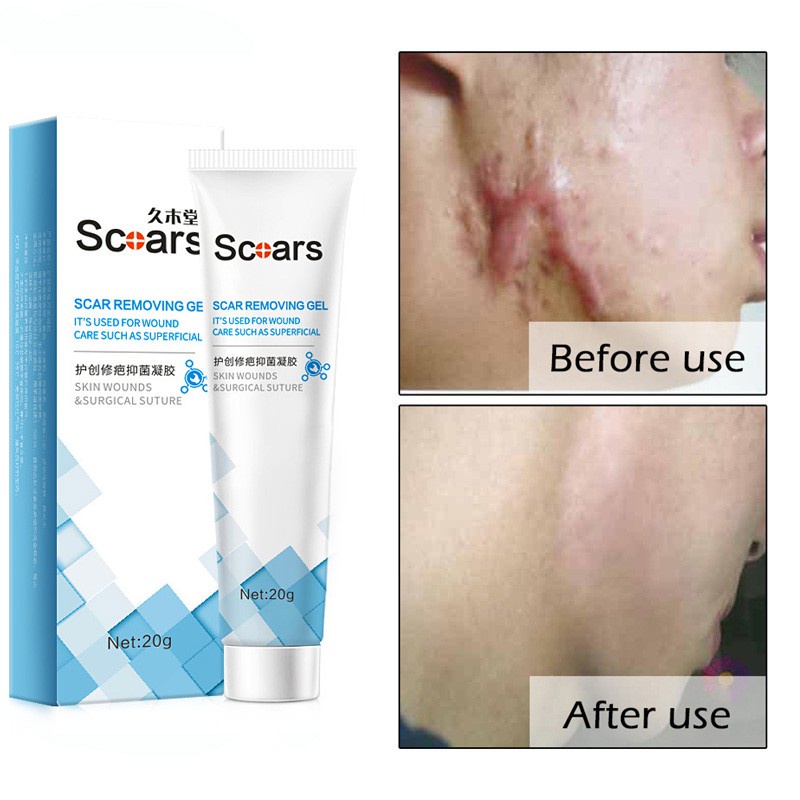 Scar Repair Cream Lighten Pimple Marks Melanin Brighten Scars Removal ...