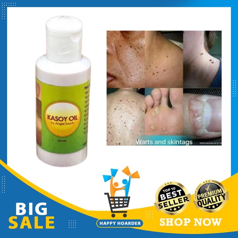 KASOY OIL WARTS REMOVAL, SKIN CARE WARTS REMOVER, KASOY OIL ANTI WARTS ...