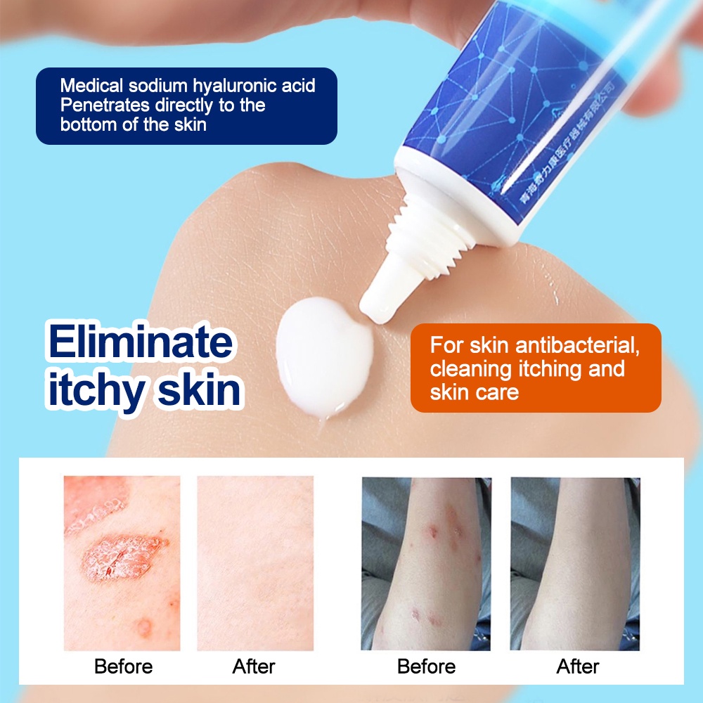 ☏ↂShingles Cream 15g Treatment Genital Herpes Natural Formula Herpes Medicine gamot sa buni for