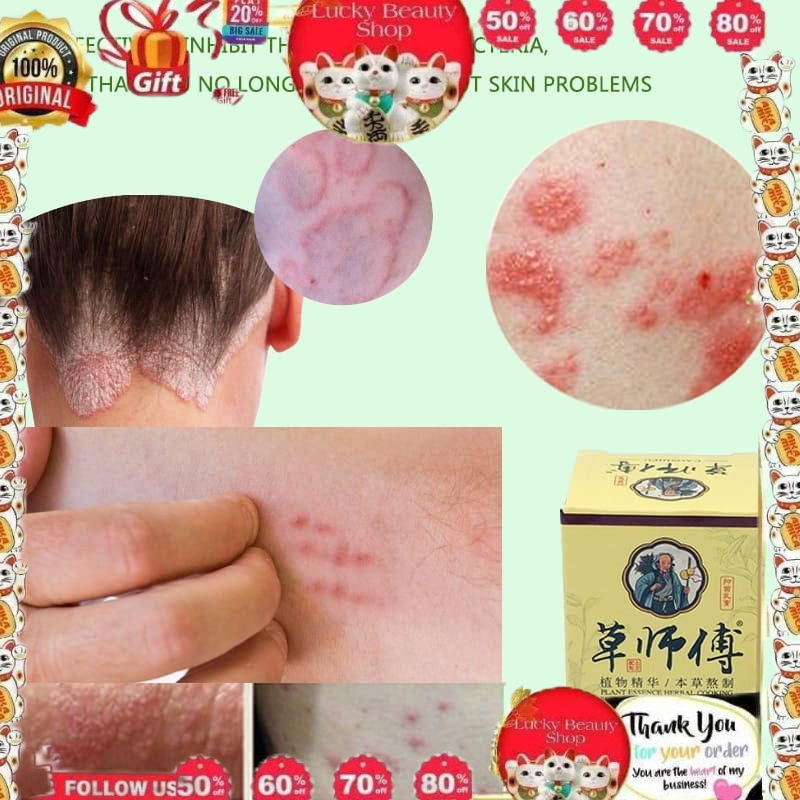 CAOSHIFU Eczema Psoriasis Treatment Cream Chinese Herbs Antifungal