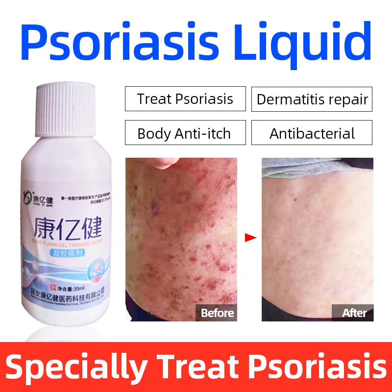Medicine Herbal Psoriasis Dermatitis Cream Liquid Eczema Pruritus Body